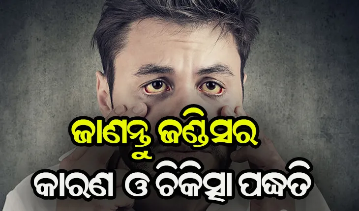 ଜାଣନ୍ତୁ ଜଣ୍ଡିସର କାରଣ ଓ କିପରି କରିବେ ନିରାକରଣ