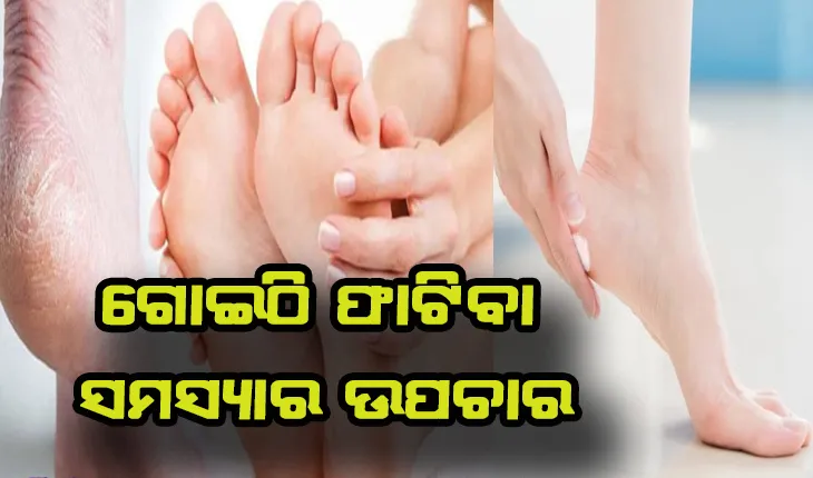 ଗୋଇଠି ଫାଟିବା ସମସ୍ଯାର ସମାଧନ ପାଇଁ ଜାଣନ୍ତୁ ଉପଚାର