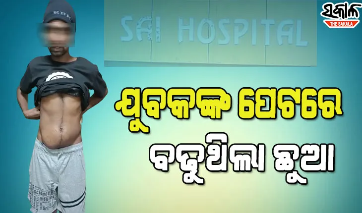 ଯୁବକଙ୍କ ପେଟରୁ ବାହାରିଲା ମଣିଷାକୃତିର ମସ୍ତିଷ୍କ, ୬ଟି ଦାନ୍ତ ଓ ଚୁଟି ମିଶା ମାଂସପିଣ୍ଡୁଳା