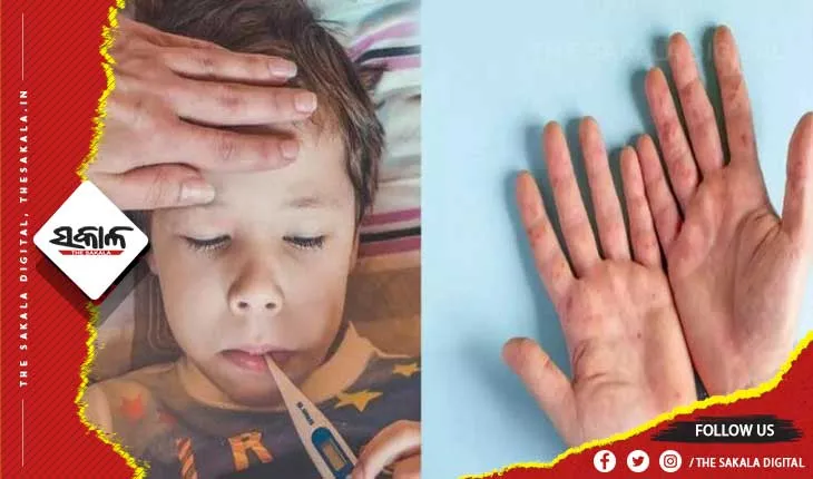 କେରଳରେ ‘ଟମାଟୋ ଫ୍ଲୁ’: ୮୦ରୁ ଊର୍ଦ୍ଧ୍ବ ଶିଶୁ ଆକ୍ରାନ୍ତ