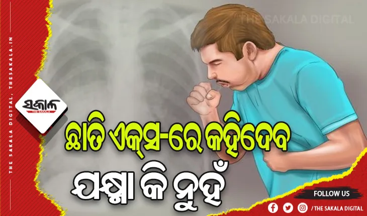 ଯକ୍ଷ୍ମା ନିରାକରଣରେ ‘ଆର୍ଟିଫିସିଆଲ୍‍ ଇଣ୍ଟେଲିଜେନ୍ସ ଟିବି’: ଛାତି ଏକ୍‍ସ-ରେ କହିଦେବ ଯକ୍ଷ୍ମା କି ନୁହଁ