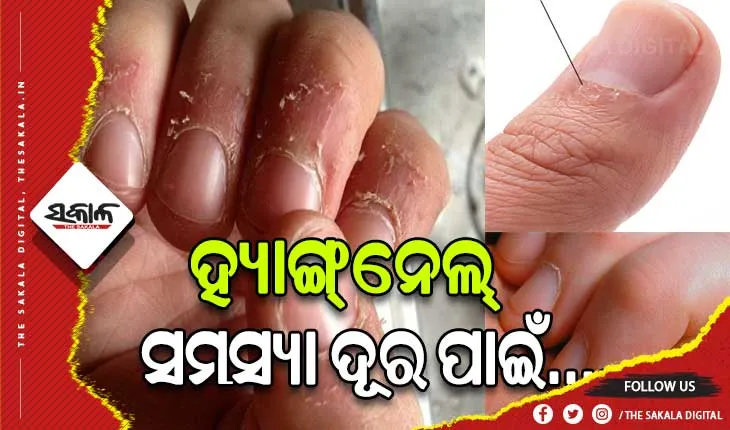 ହ୍ୟାଙ୍ଗ୍‌ନେଲ୍‌ ସମସ୍ୟା ଦୂର ପାଇଁ ଜାଣନ୍ତୁ ଉପଚାର…..