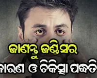 ଜାଣନ୍ତୁ ଜଣ୍ଡିସର କାରଣ ଓ କିପରି କରିବେ ନିରାକରଣ
