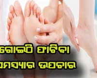 ଗୋଇଠି ଫାଟିବା ସମସ୍ଯାର ସମାଧନ ପାଇଁ ଜାଣନ୍ତୁ ଉପଚାର