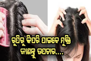 କିପରି ପାଇବେ ରୁପି ସମସ୍ଯାରୁ ମୁକ୍ତି, ଜାଣନ୍ତୁ ଉପଚାର