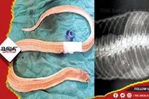 ଓୟୁଏଟିରେ ଦୀର୍ଘ ଦେଢ଼ ଘଣ୍ଟାର ଅପରେସନ ପରେ ତମ୍ପ ପେଟରୁ ବାହାରିଲା ବୋତଲ ଠିପି