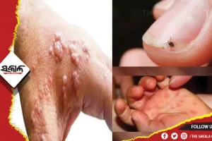 ଚିନ୍ତା ବଢ଼ାଉଛି ମଙ୍କିପକ୍ସ, ସ୍କ୍ରବ୍‌ ଥାଇପସ୍‌ ଓ ଟମାଟୋ ଫ୍ଲୁ