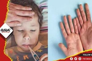 କେରଳରେ ‘ଟମାଟୋ ଫ୍ଲୁ’: ୮୦ରୁ ଊର୍ଦ୍ଧ୍ବ ଶିଶୁ ଆକ୍ରାନ୍ତ
