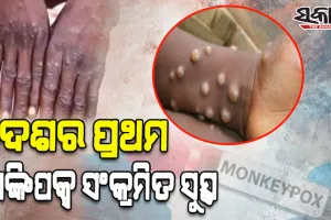 ସୁସ୍ଥହେଲେ ଭାରତର ପ୍ରଥମ ମଙ୍କିପକ୍ସ ଆକ୍ରାନ୍ତ ବ୍ୟକ୍ତି