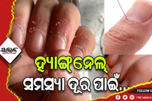 ହ୍ୟାଙ୍ଗ୍‌ନେଲ୍‌ ସମସ୍ୟା ଦୂର ପାଇଁ ଜାଣନ୍ତୁ ଉପଚାର…..