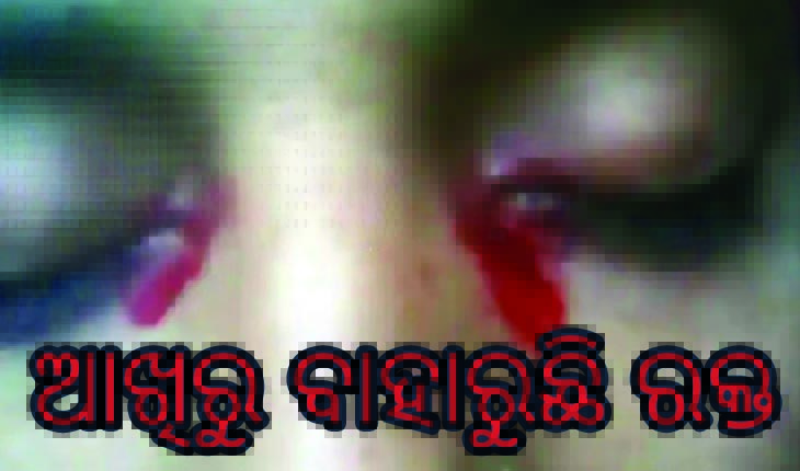 ଅଜବ ରୋଗ: ଆଖିରୁ ବାହାରୁଛି ରକ୍ତ