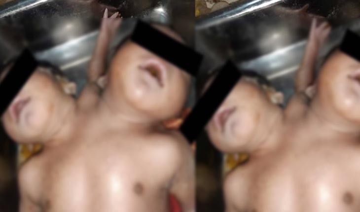 ଜନ୍ମ ନେଲା ଅଦ୍ଭୁତ ଶିଶୁକନ୍ୟା, ଗୋଟିଏ ଦେହରେ ରହିଛି ଦୁଇଟି ମୁଣ୍ଡ