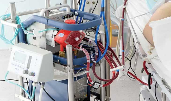 ଅଗଷ୍ଟ ୧୫ରୁ ଏସ୍‌ସିବିରେ ଆରମ୍ଭ ହେବ କରୋନା ରୋଗୀଙ୍କ ECMO ଚିକିତ୍ସା