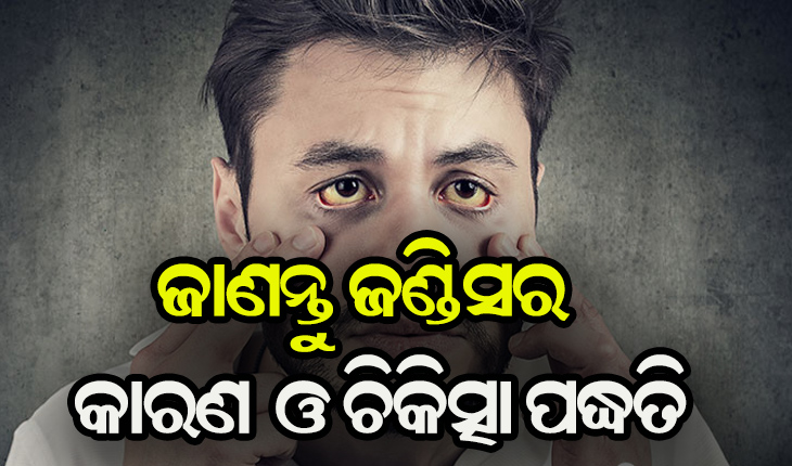 ଜାଣନ୍ତୁ ଜଣ୍ଡିସର କାରଣ ଓ କିପରି କରିବେ ନିରାକରଣ