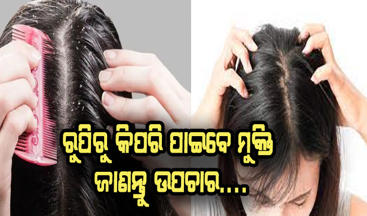 କିପରି ପାଇବେ ରୁପି ସମସ୍ଯାରୁ ମୁକ୍ତି, ଜାଣନ୍ତୁ ଉପଚାର