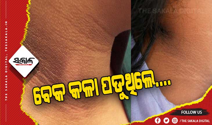 ଜାଣନ୍ତୁ କିଭଳି ଦୂର ହେବ ବେକର କଳା ଦାଗ ସମସ୍ୟା….