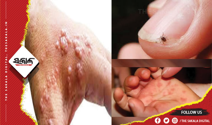 ଚିନ୍ତା ବଢ଼ାଉଛି ମଙ୍କିପକ୍ସ, ସ୍କ୍ରବ୍‌ ଥାଇପସ୍‌ ଓ ଟମାଟୋ ଫ୍ଲୁ