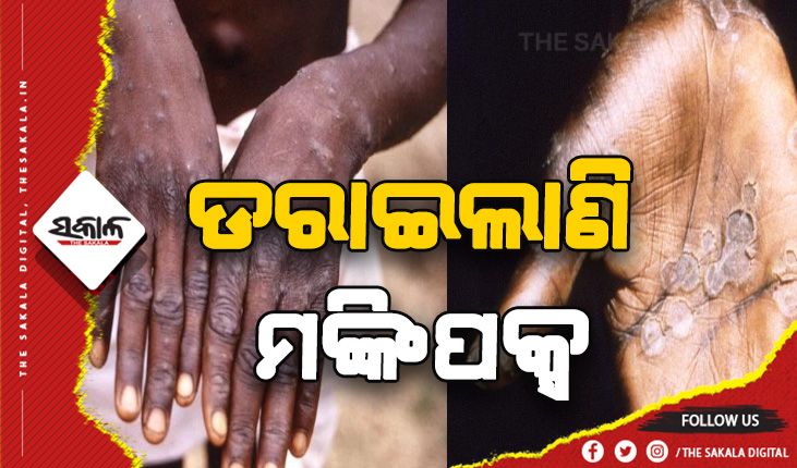 ଦ୍ରୁତ ଗତିରେ ମାଡ଼ି ଚାଲିଛି ମଙ୍କିପକ୍ସ: ୨୦ରୁ ଅଧିକ ଦେଶରୁ ୨୦୦ ଆକ୍ରାନ୍ତ ଚିହ୍ନଟ