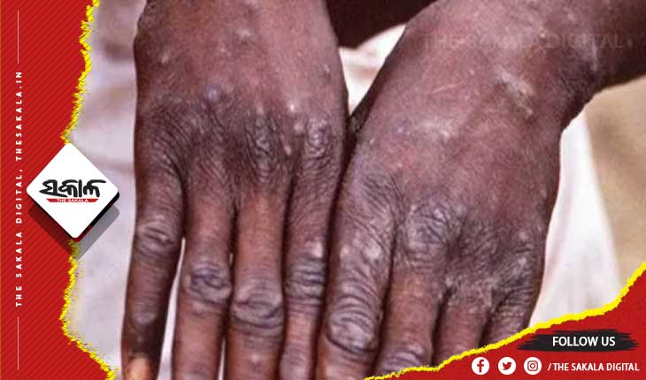 କେରଳରେ ପ୍ରଥମ ମଙ୍କିପକ୍ସ ଚିହ୍ନଟ