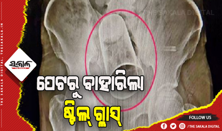 ମଦ୍ଯପ ସାଙ୍ଗଙ୍କ ଉନ୍ମତ କାଣ୍ଡ: ମଳଦ୍ବାର ପଟେ ଜୋରଜବରଦସ୍ତ ଭର୍ତ୍ତି କରାଇଲେ ଷ୍ଟିଲ ଗ୍ଲାସ