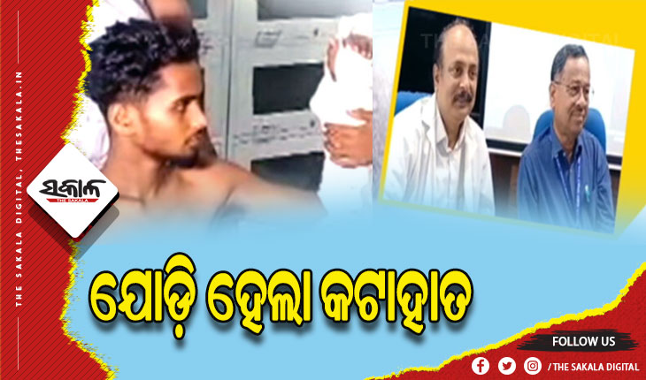 କଟକ ଏସସିବି ମେଡିକାଲରେ ବିରଳ ଅସ୍ତ୍ରୋପଚାର, ଯୋଡିହେଲା କଟାହାତ