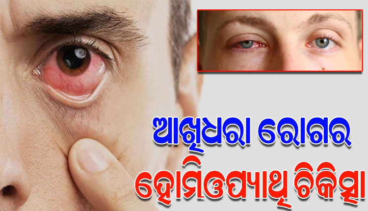 ଦ୍ରୁତଗତିରେ ବଢ଼ିଚାଲିଛି ଆଖିଧରା ରୋଗ, ଜାଣନ୍ତୁ କ’ଣ ରହିଛି ଏହାର ହୋମିଓପ୍ୟାଥି ଚିକିତ୍ସା ଓ ପ୍ରତିଷେଧକ…