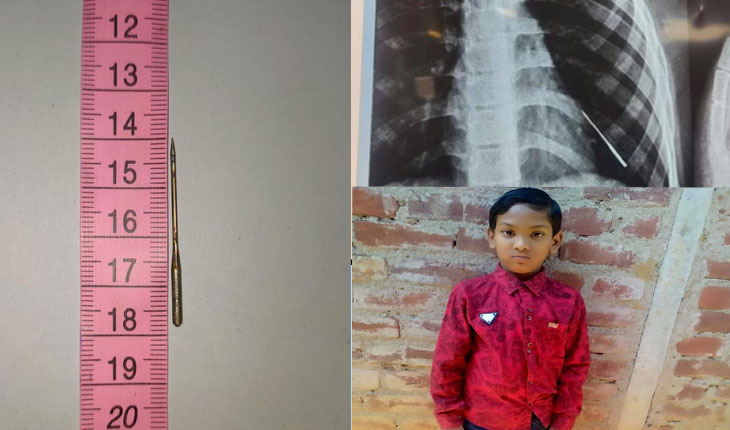 ବିନା ଅସ୍ତ୍ରୋପଚାରରେ ବାହାରିଲା ଛୁଞ୍ଚି, ନୂଆ ଜୀବନ ଦେଲା ଭୁବନେଶ୍ୱର ଏମ୍ସ