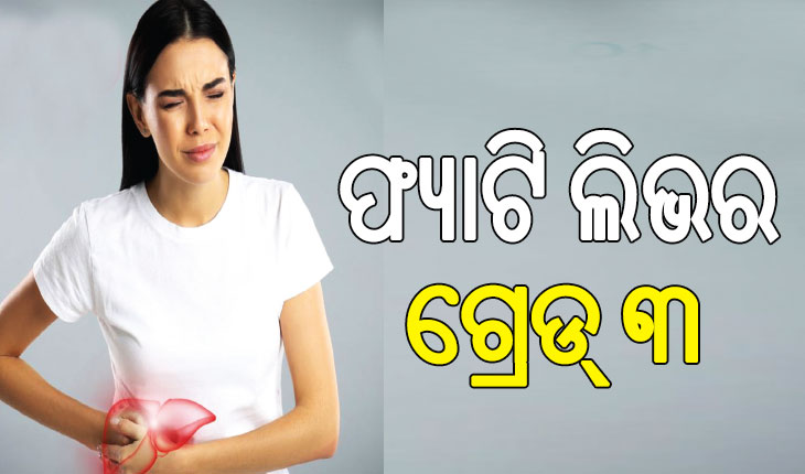 ଫ୍ୟାଟି ଲିଭର ଗ୍ରେଡ୍‌ ୩ କ’ଣ.., ଜାଣନ୍ତୁ ଏହା କେତେ ବିପଦ ଜନକ…