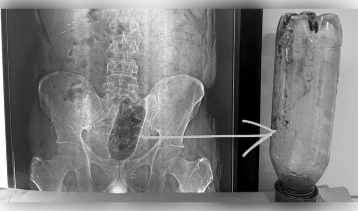 ଆଗ୍ରାରେ ଆଶ୍ଚର୍ଯ୍ୟଜନକ ଘଟଣା: ଯୁବକଙ୍କ ମଳଦ୍ୱାରରେ ଫସିଲା ୧ ଲିଟର ପାଣି ବୋତଲ, ଅସ୍ତ୍ରୋପଚାର ପରେ ବଞ୍ଚିଲା ଜୀବନ