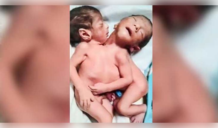 ଅଲିଗଡ଼ରେ ବିରଳ ଯମଜ ଶିଶୁଙ୍କ ଜନ୍ମ: ଦୁଇଟି ମୁଣ୍ଡ, ଚାରିଟି ଗୋଡ଼ ଓ ଗୋଟିଏ ହୃଦୟ; ଦେଖିବା ମାତ୍ରେ ସଦମାରେ ମା'ଙ୍କର ମୃତ୍ୟୁ