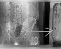 ଆଗ୍ରାରେ ଆଶ୍ଚର୍ଯ୍ୟଜନକ ଘଟଣା: ଯୁବକଙ୍କ ମଳଦ୍ୱାରରେ ଫସିଲା ୧ ଲିଟର ପାଣି ବୋତଲ, ଅସ୍ତ୍ରୋପଚାର ପରେ ବଞ୍ଚିଲା ଜୀବନ