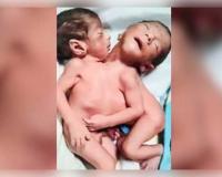 ଅଲିଗଡ଼ରେ ବିରଳ ଯମଜ ଶିଶୁଙ୍କ ଜନ୍ମ: ଦୁଇଟି ମୁଣ୍ଡ, ଚାରିଟି ଗୋଡ଼ ଓ ଗୋଟିଏ ହୃଦୟ; ଦେଖିବା ମାତ୍ରେ ସଦମାରେ ମା'ଙ୍କର ମୃତ୍ୟୁ