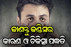 ଜାଣନ୍ତୁ ଜଣ୍ଡିସର କାରଣ ଓ କିପରି କରିବେ ନିରାକରଣ