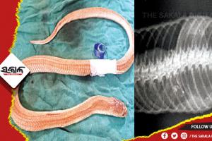 ଓୟୁଏଟିରେ ଦୀର୍ଘ ଦେଢ଼ ଘଣ୍ଟାର ଅପରେସନ ପରେ ତମ୍ପ ପେଟରୁ ବାହାରିଲା ବୋତଲ ଠିପି