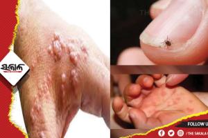 ଚିନ୍ତା ବଢ଼ାଉଛି ମଙ୍କିପକ୍ସ, ସ୍କ୍ରବ୍‌ ଥାଇପସ୍‌ ଓ ଟମାଟୋ ଫ୍ଲୁ