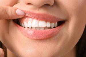 ଦାନ୍ତ ଏବଂ ମାଢ଼ିକୁ କେମିତି ରଖିବେ ସୁସ୍ଥ, ଜାଣନ୍ତୁ ଏହାର ଆୟୁର୍ବେଦିକ ଉପାୟ…