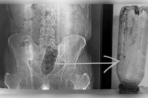 ଆଗ୍ରାରେ ଆଶ୍ଚର୍ଯ୍ୟଜନକ ଘଟଣା: ଯୁବକଙ୍କ ମଳଦ୍ୱାରରେ ଫସିଲା ୧ ଲିଟର ପାଣି ବୋତଲ, ଅସ୍ତ୍ରୋପଚାର ପରେ ବଞ୍ଚିଲା ଜୀବନ