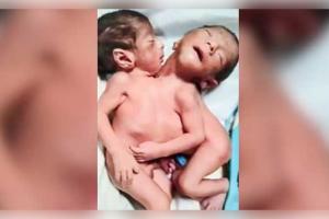 ଅଲିଗଡ଼ରେ ବିରଳ ଯମଜ ଶିଶୁଙ୍କ ଜନ୍ମ: ଦୁଇଟି ମୁଣ୍ଡ, ଚାରିଟି ଗୋଡ଼ ଓ ଗୋଟିଏ ହୃଦୟ; ଦେଖିବା ମାତ୍ରେ ସଦମାରେ ମା'ଙ୍କର ମୃତ୍ୟୁ